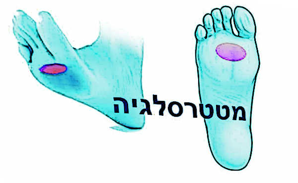 אזור הכאבים האופייני למטטרסלגיה